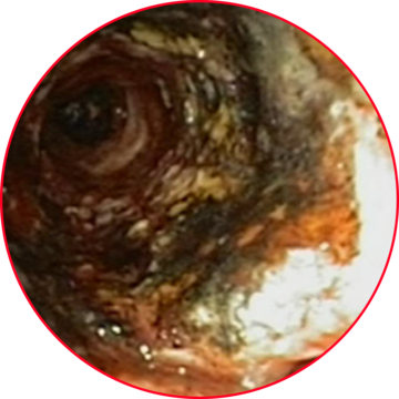 Coagulated granulation tissue Coagulated granulation tissue