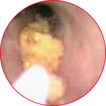 Illustration of a kidney stone for medical documentation
