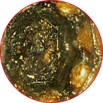 Exposed stent after interventional treatment