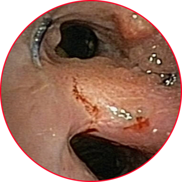 Illustration of a metal stent fixed in the tissue